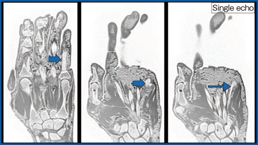 図5　CT like imageによる指屈筋腱断裂の評価