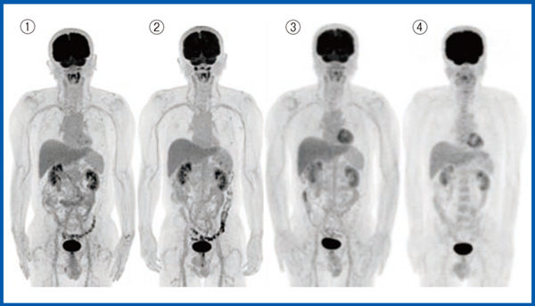 図9　異なる装置による同一患者の画像 （答え）(1)SiPM-PET-CT，(2)Cartesion Prime / Luminous Edition，(3)PMT-PET-CT，(4)non-TOF-PET