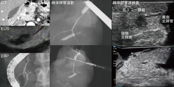 図1　標本造影/超音波検査を行った症例 主膵管狭窄を伴う6mm大の腫瘤病変がセロトニン産生性PanNET G1と確認できた。
