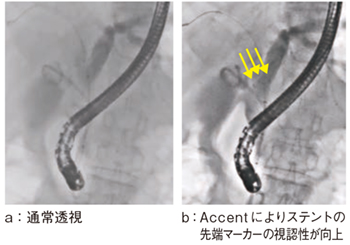 図5　症例2：膵がん症例（Accent適用）