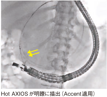 図7　症例4：仮性囊胞症例（Accent適用）