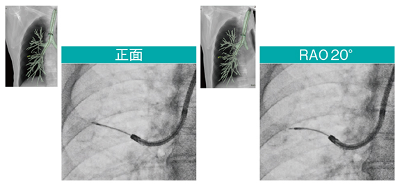 図5　Cアームの角度付けによる透視像の比較 Accent適用、スコープ：BF-P290、ガイドシース：SG-400C、EBUS：US-S20-20R（オリンパス社製）