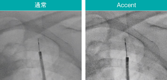 図7　AccentによるEBUSプローブや関心領域の強調 スコープ：BF-MP290、EBUS：UM-S20-17S（オリンパス社製）
