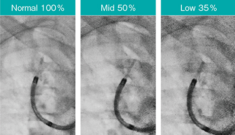 図11　透視線量モードによる画質の比較 Accent適用、スコープ：BF-P290、ガイドシース：SG-400C（オリンパス社製）