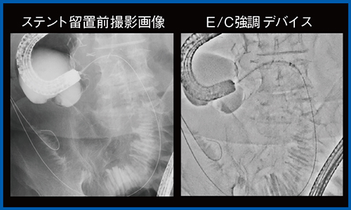 図9　腸管ステント留置（Accent適用）
