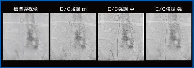 図6　尿管ステント（Accent適用）