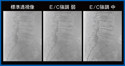 図8　脊髄腔造影（Accent＋Live像輝度調整を適用）