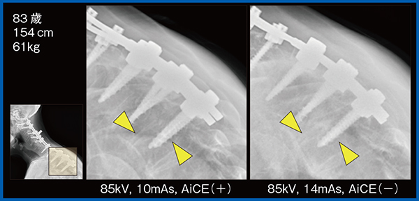 図1　整形症例でのAiCEによる低線量化およびノイズ低減効果