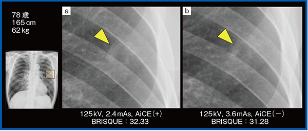 図5　呼吸器症例におけるAiCE導入前後の比較