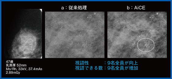 図5　症例2：拡大撮影における石灰化の評価