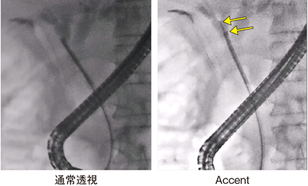 図3　胆管内乳頭状腫瘍（IPNB）の胆道鏡下マッピング生検生検鉗子（←）