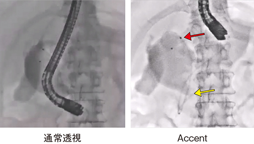 図6　症例2：膵管ステントとENBDチューブ（5Fr）の留置 Accent適用下では、膵管ステント（←）、ENBDチューブ（←）の視認性が向上
