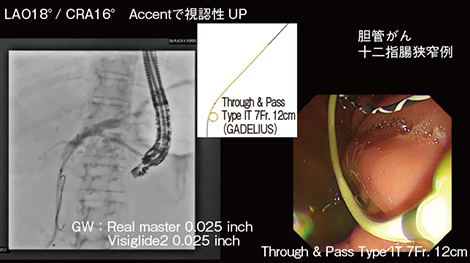 図5　Accent適用により視認性が向上 （胆管がん・十二指腸狭窄例）