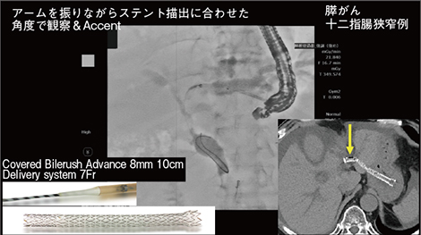 図6　症例1：膵がん・十二指腸狭窄例