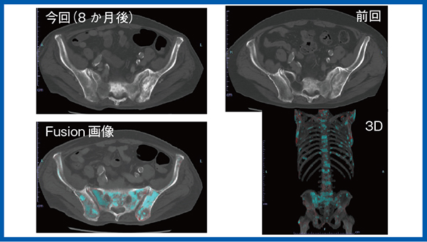 図2　症例1：前立腺がん術後