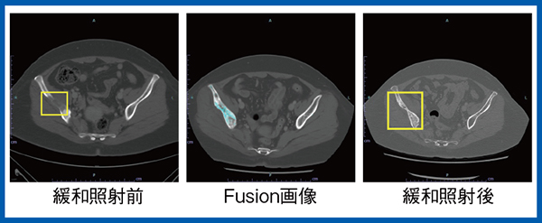図5　症例4：乳がんの右腸骨転移に対する緩和照射後