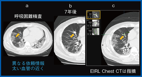 図2　EIRL Chest CTによる見逃し病変の検出