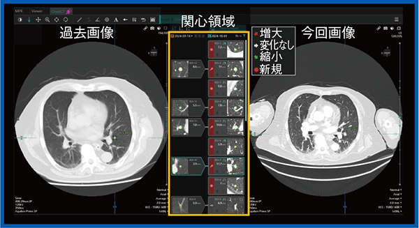 図3　EIRL Chest CTによる過去画像比較