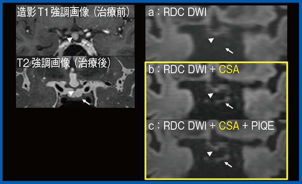図6　症例4：下垂体柄転移性腫瘍疑い治療後