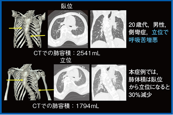 図1　臥位と立位における肺体積の変化
