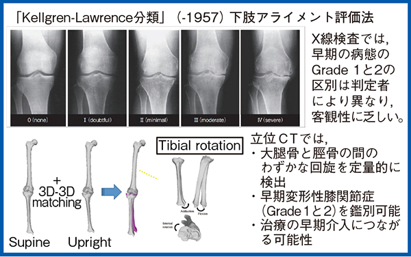 図2　変形性膝関節症の早期診断