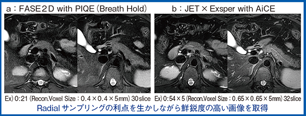 図1　JET × ExsperによるT2強調画像の画質改善（慢性膵炎疑い）