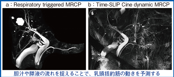 図3　Cine dynamic MRCPへのTime-SLIPの応用（SOD疑い）