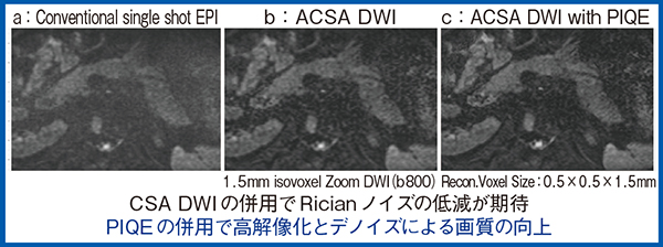 図5　ACSA DWI ＋ PIQEによる画質改善
