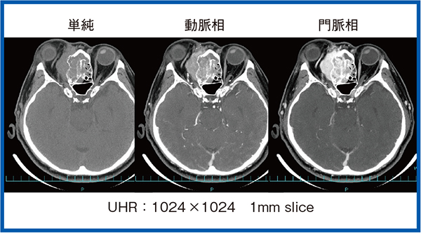 図4　症例1：嗅神経芽細胞腫の造影CT画像