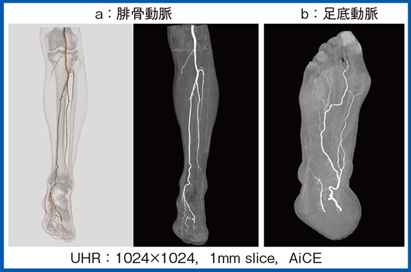 図7　症例2：左頬粘液癌における腓骨動脈の走行確認目的のCTA