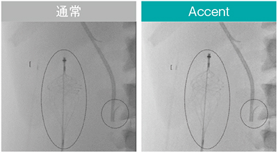 図5　新画像処理条件Accentによる視認性の向上