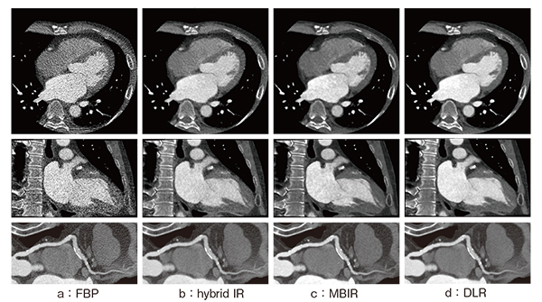 図1　心臓CTにおける従来法とDLRの画像比較