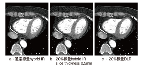 図2　低線量心臓CTにおけるDLRの初期検討（拡張中期）