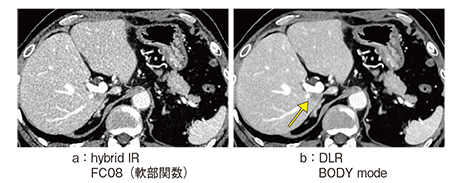 図3　転移性肝腫瘍におけるhybrid IRとDLRの比較