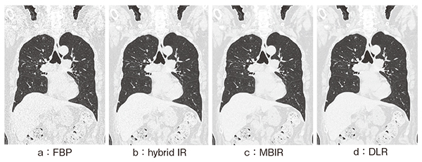 図4　通常線量胸部CT（8.6mGy）におけるDLRの初期検討