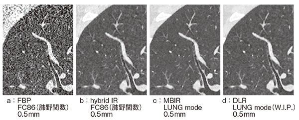 図5　低線量肺がんCT検診（1.5mGy）におけるDLRの初期検討