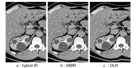図7　腹部の超高精細CTにおけるDLRの初期検討