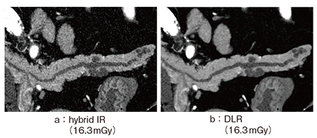 図8　超高精細CTを用いたhybrid IRとDLRによるIPMNの描出
