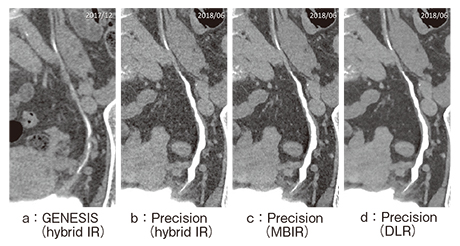図9　ADCTと超高精細CTによるCTUの各再構成法の画像比較