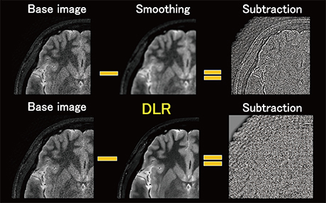図4　スムージングとDLRによるノイズ除去の比較