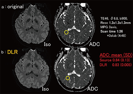 図7　全脳の高分解能拡散強調画像におけるADC値の比較