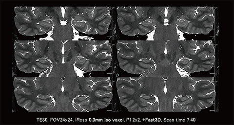 図13　3mm iso voxelの3D-T2強調画像におけるDLRによるフローアーチファクトの低減