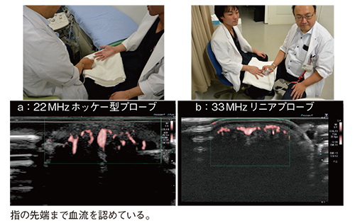 図13　33MHz超・超高周波リニアプローブによる指先直下からの血流評価