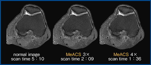 図7　脂肪抑制画像におけるMeACSの有用性（W.I.P.）