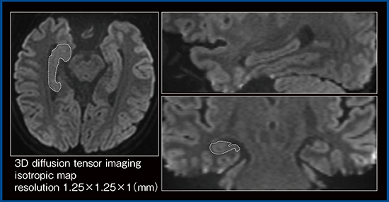 図4　Galan ZGOによる高分解能拡散強調画像（3D DTI）での海馬の特定（W.I.P.）