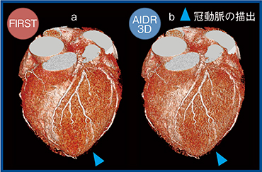 図6　VR画像での冠動脈描出能の比較