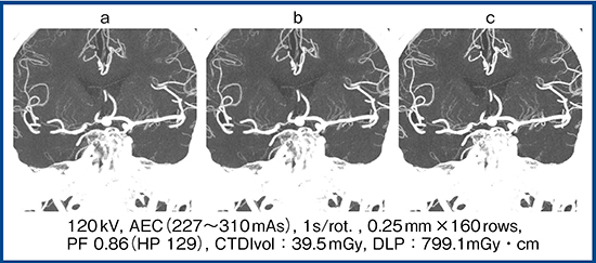 図1　画像再構成法による脳底動静脈の描出能の比較 a：FBP　b：AIDR 3D　c：FIRST