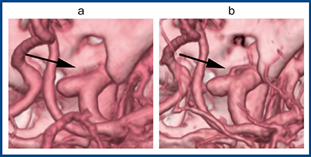 図3　内頸動脈眼動脈瘤の3D再構成画像 a：ADCT　b：Aquilion Precision