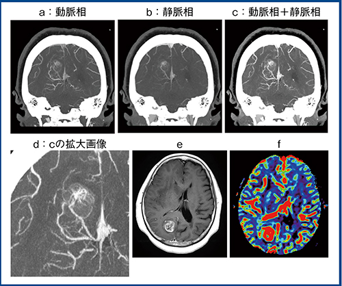 図4　悪性神経膠腫（high grade glioma）の比較画像 a〜d：Aquilion Precision　e：造影MRI　f：MR灌流画像（CBV）