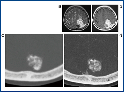 図5　髄膜腫（meningioma）の比較画像 a：T2強調画像　b：造影MRI　c：ADCT　d：Aquilion Precision